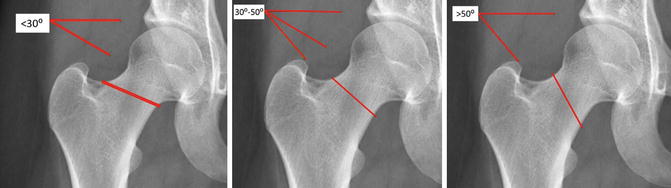 Hip Fractures Springerlink