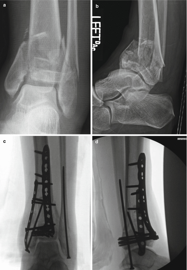 Pilon Fractures Springerlink