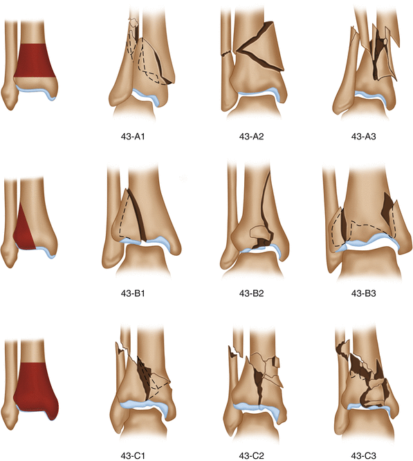 Pilon Fractures Springerlink