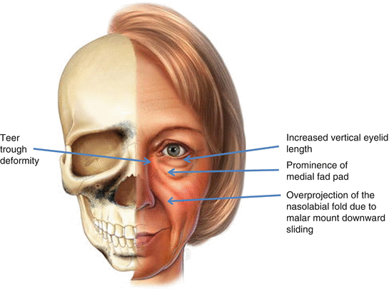 Anatomy Of The Periorbital Region Springerlink