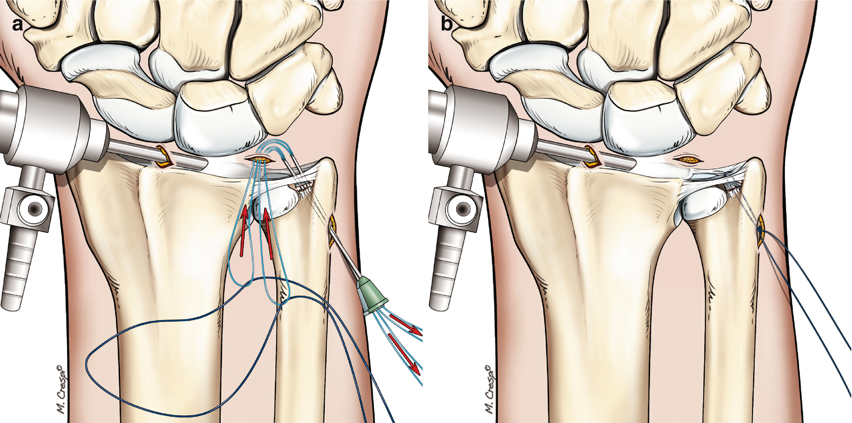 Tfcc Lesion In Kendo Player Springerlink