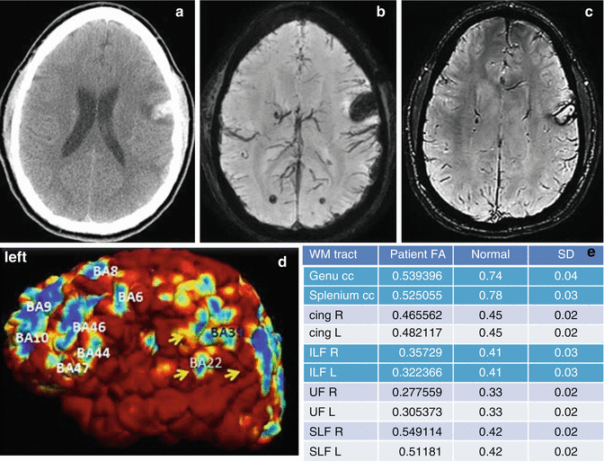 Utility Of Magnetic Resonance Findings In Elucidating Structural And Functional Brain Impairment In Traumatic Brain Injury Springerlink