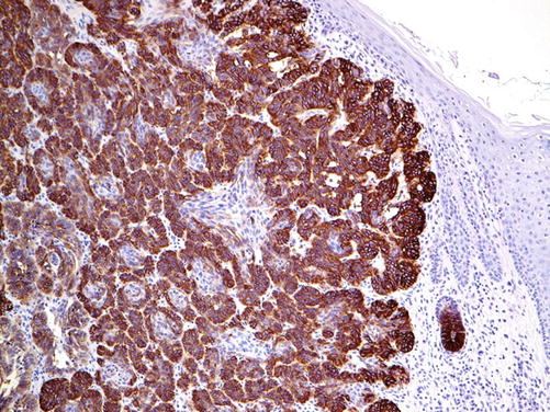 Markers And Immunoprofile Of Skin Tumors Springerlink Markers And Immunoprofile Of Skin Tumors Springerlink