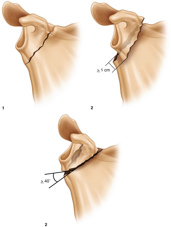Scapula Fractures SpringerLink