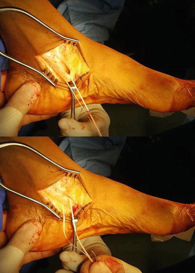 Complications of Stage II Flatfoot Surgery | SpringerLink Complications of Stage II Flatfoot Surgery | SpringerLink