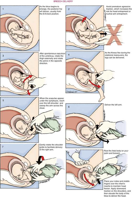 Precipitous Labor And Emergency Department Delivery Springerlink
