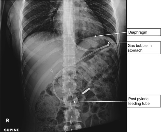 40++ Post pyloric feeding tube