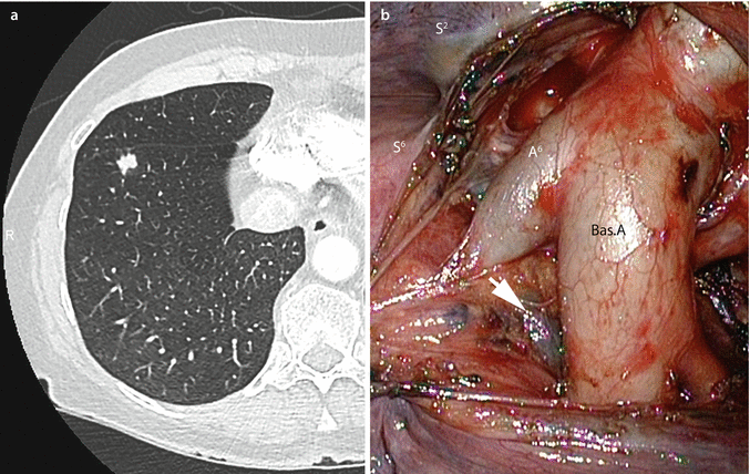Thoracoscopic Lymph Node Dissection | SpringerLink
