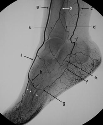 Endovascular Treatment of the Arteries of the Foot | SpringerLink