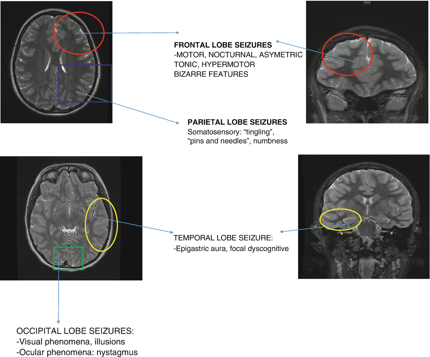 Update In Pediatric Neurology Springerlink - 