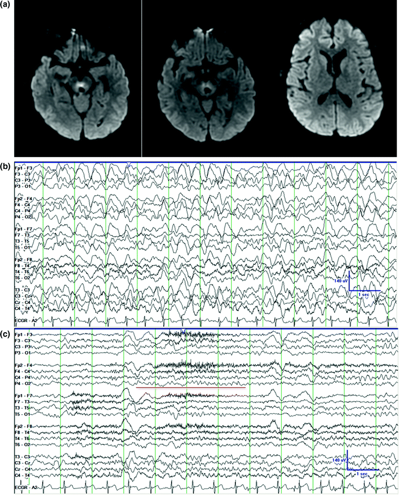 Periodic Eeg Patterns Springerlink Periodic Eeg Patterns Springerlink