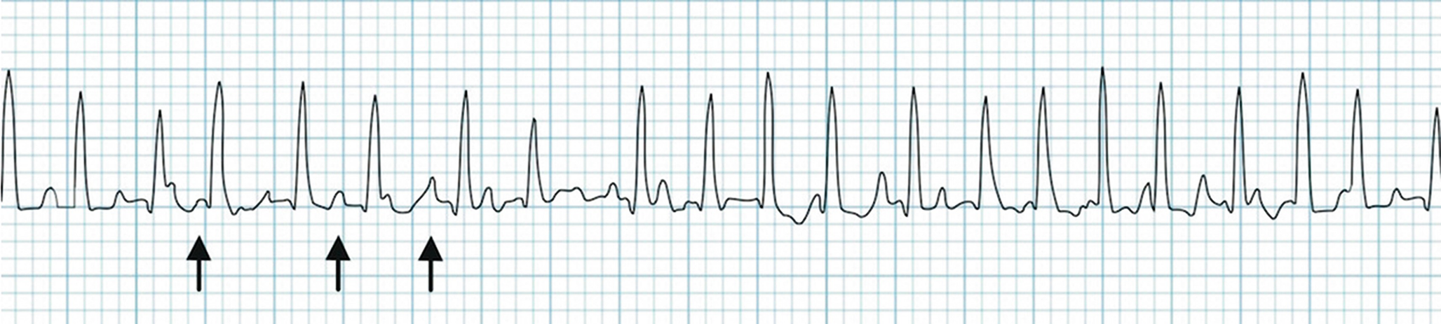 Cardiac Sinus Arrhythmias Springerlink