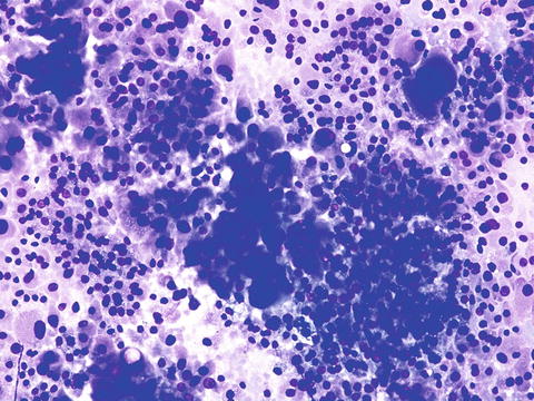Follicular Neoplasm, Hürthle Cell (Oncocytic) Type/Suspicious for a ...