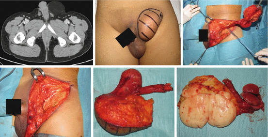 cancer de sarcoma inguinal