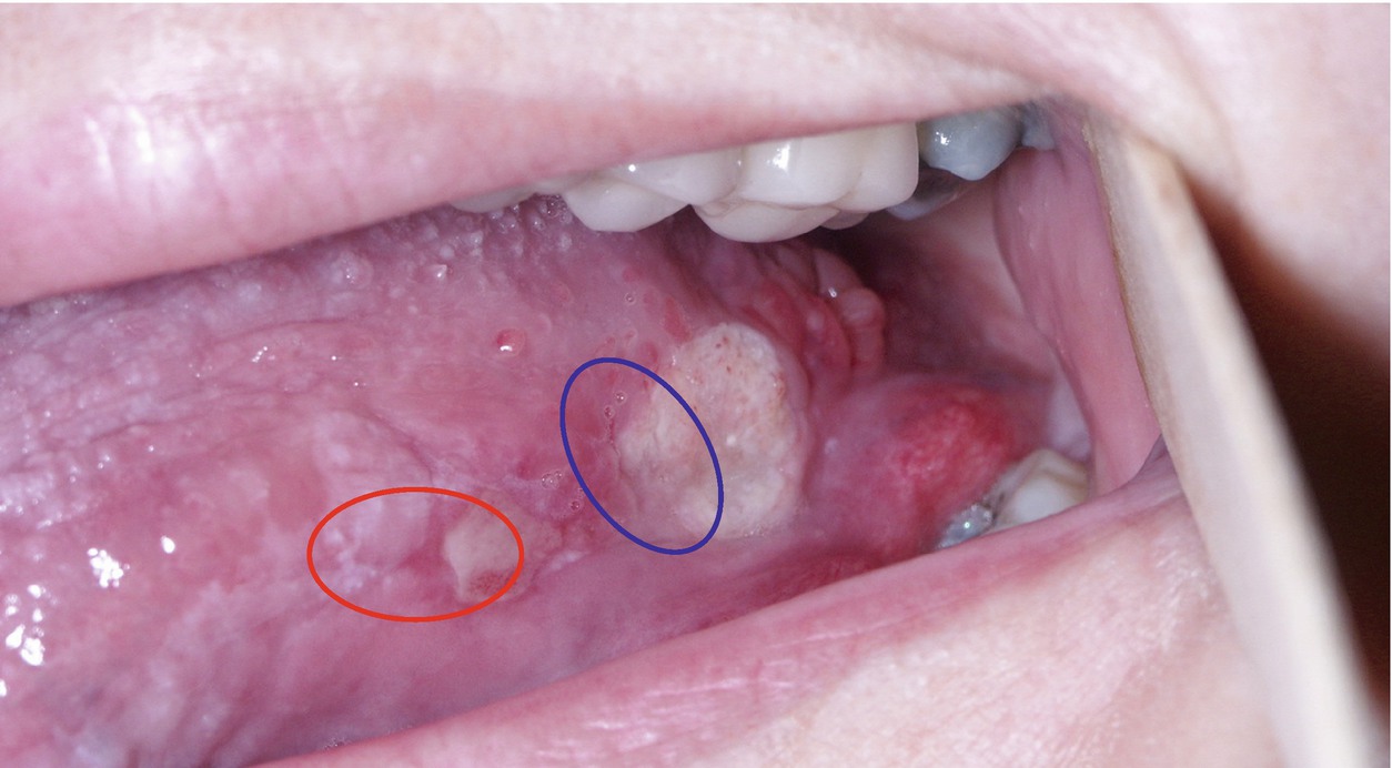 pix Punch Biopsy Tongue biopsy and oral squamous cell carcinoma