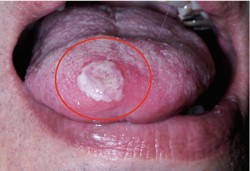 pics Punch Biopsy Tongue biopsy and oral squamous cell carcinoma