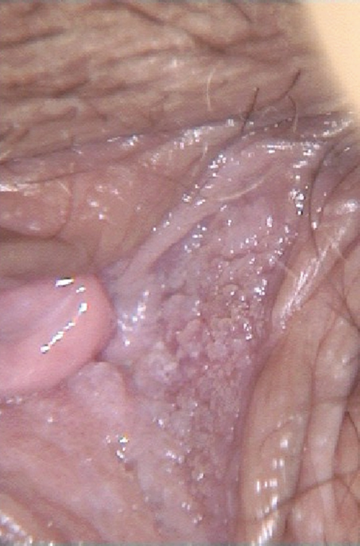 Vestibular papillomatosis common in pregnancy - monapainting.ro