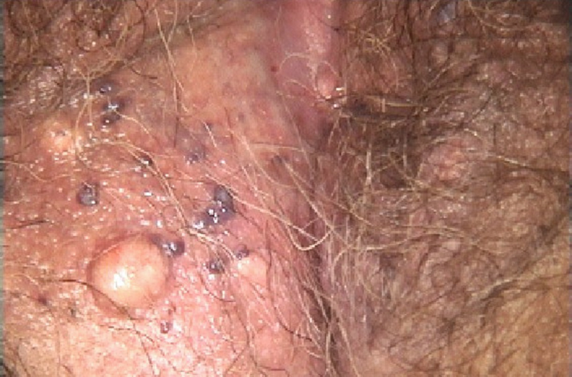 Angiokeratoma Springerlink