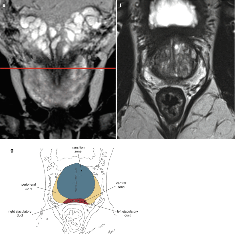 central zone tumor prostate mri