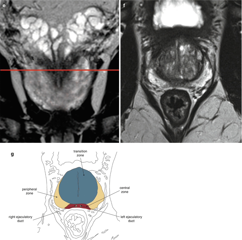 Prostatitis tomográfia