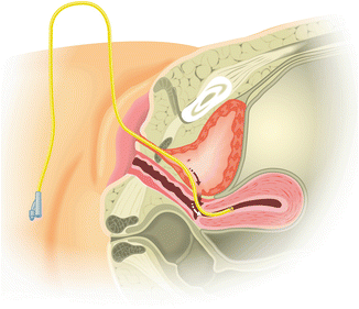 Urinary Fistulas | SpringerLink