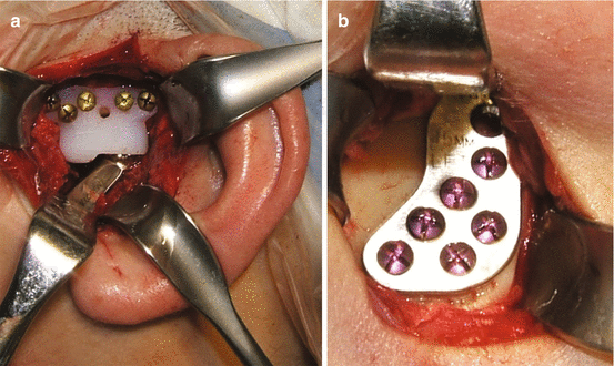 Role Of Total Joint Replacement In The Management Of Chronic Tmj