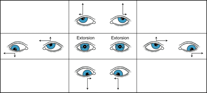 A Pattern V Pattern And Other Alphabet Pattern Strabismus