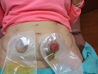robotic assisted total pelvic exenteration springerlink