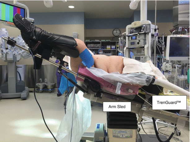 robotic assisted total pelvic exenteration springerlink