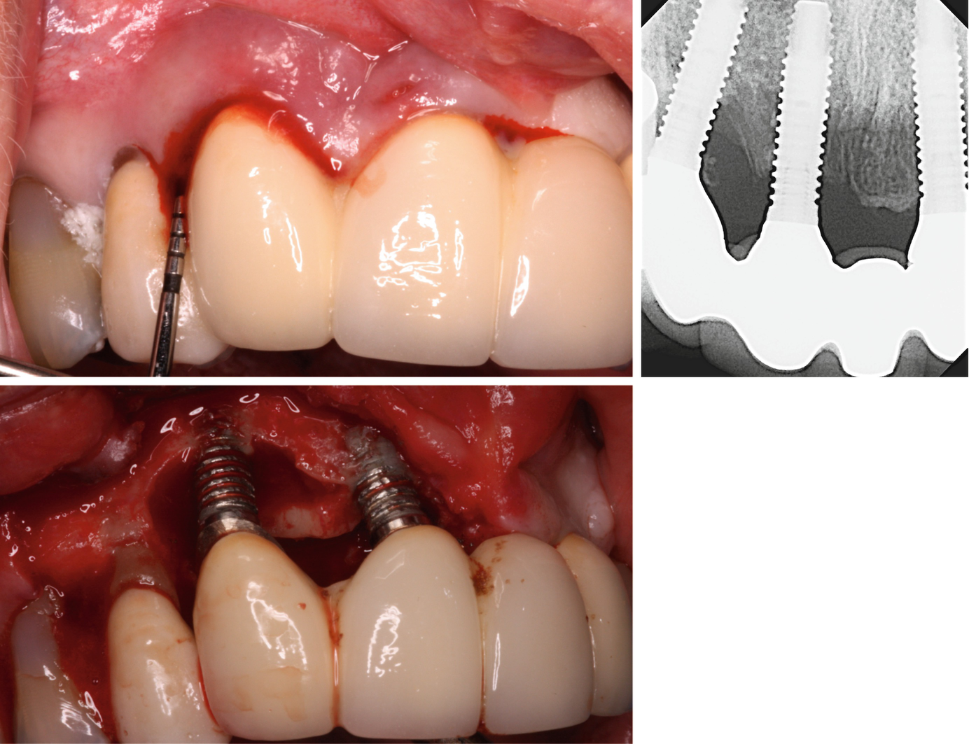 open image in new window Array - hard tissue complications peri implantitis springerlink rh link springer com