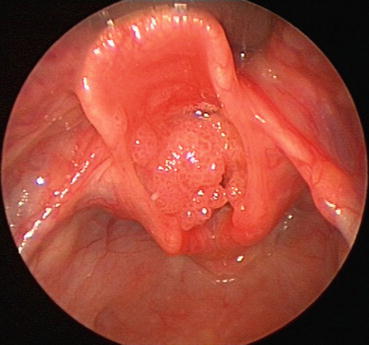 helmintox rus intraductal papilloma is it cancer