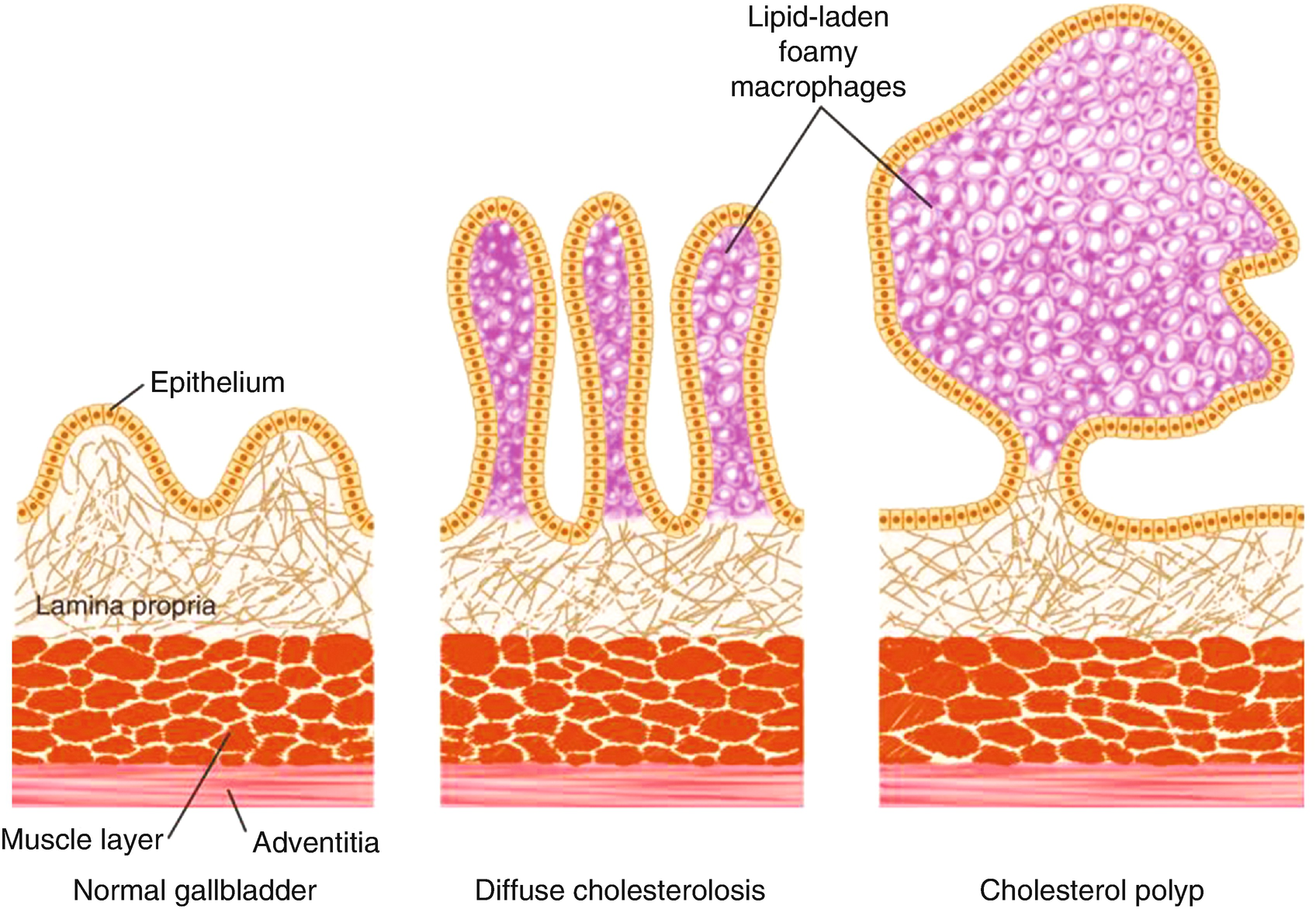 Difference between inverted papilloma and polyp.