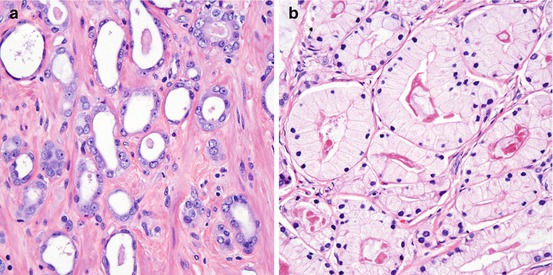 Pathology Of Prostate Cancer Springerlink
