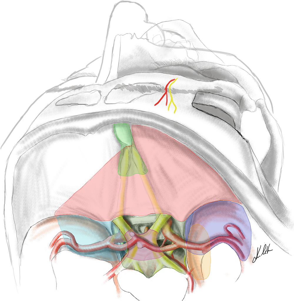 23 Intracranial Aneurysms Springerlink 23 Intracranial Aneurysms Springerlink