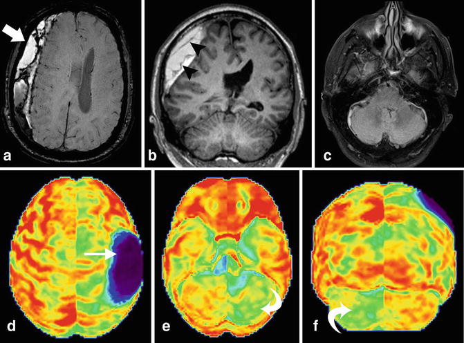 Crossed Cerebellar Diaschisis Springerlink