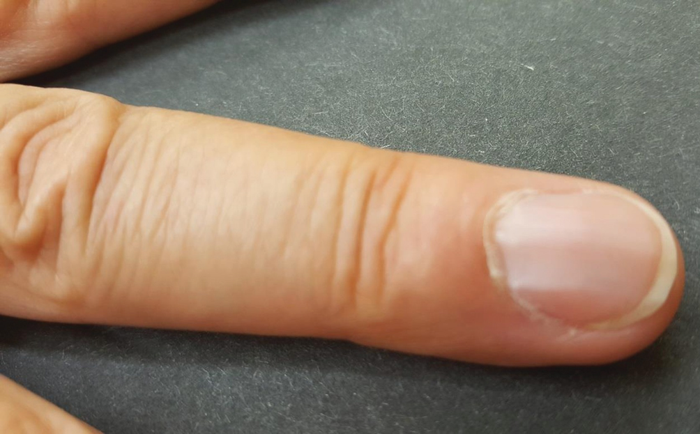 Painful Nail Springerlink Painful Nail Springerlink