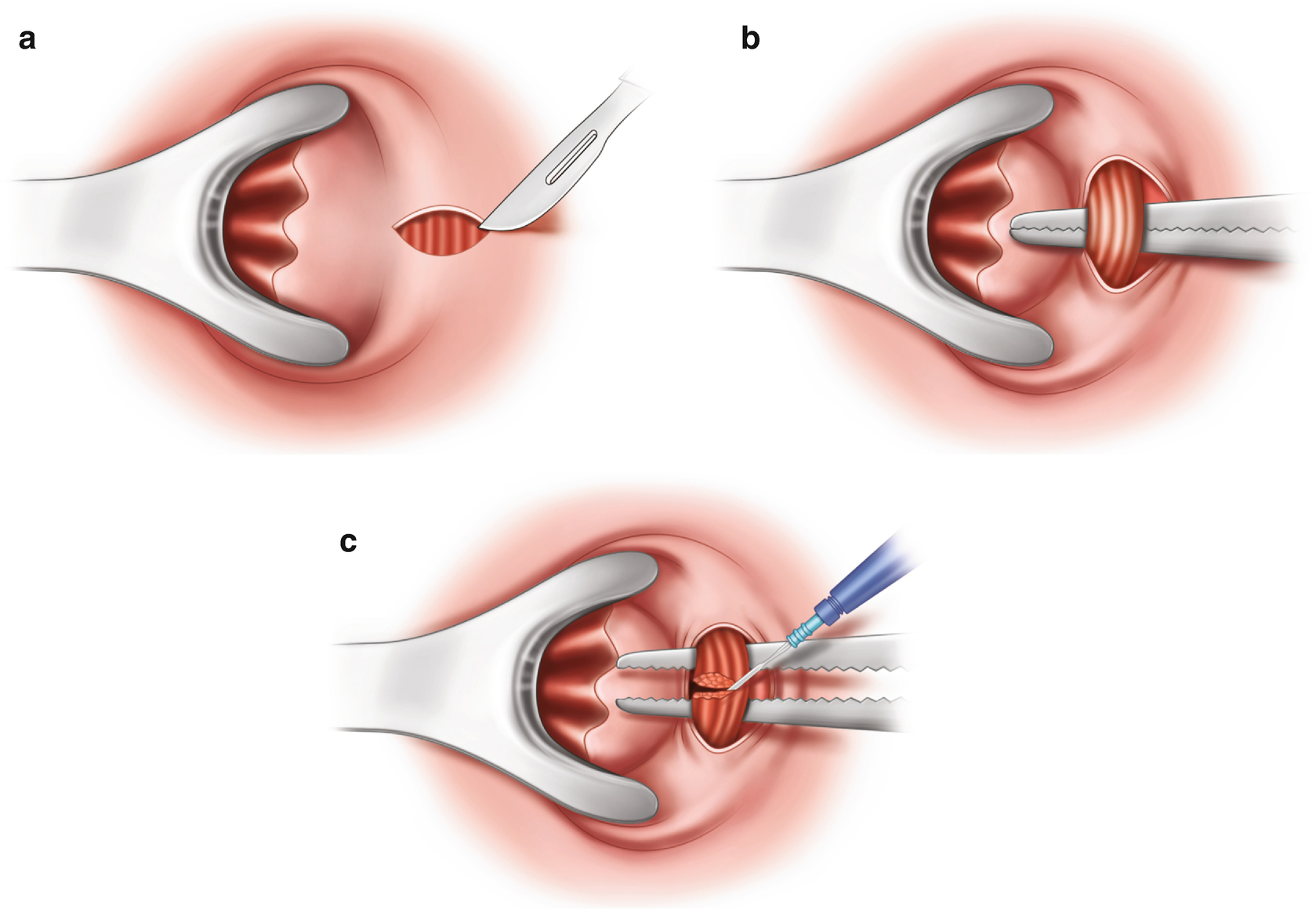 Anal stricture porn