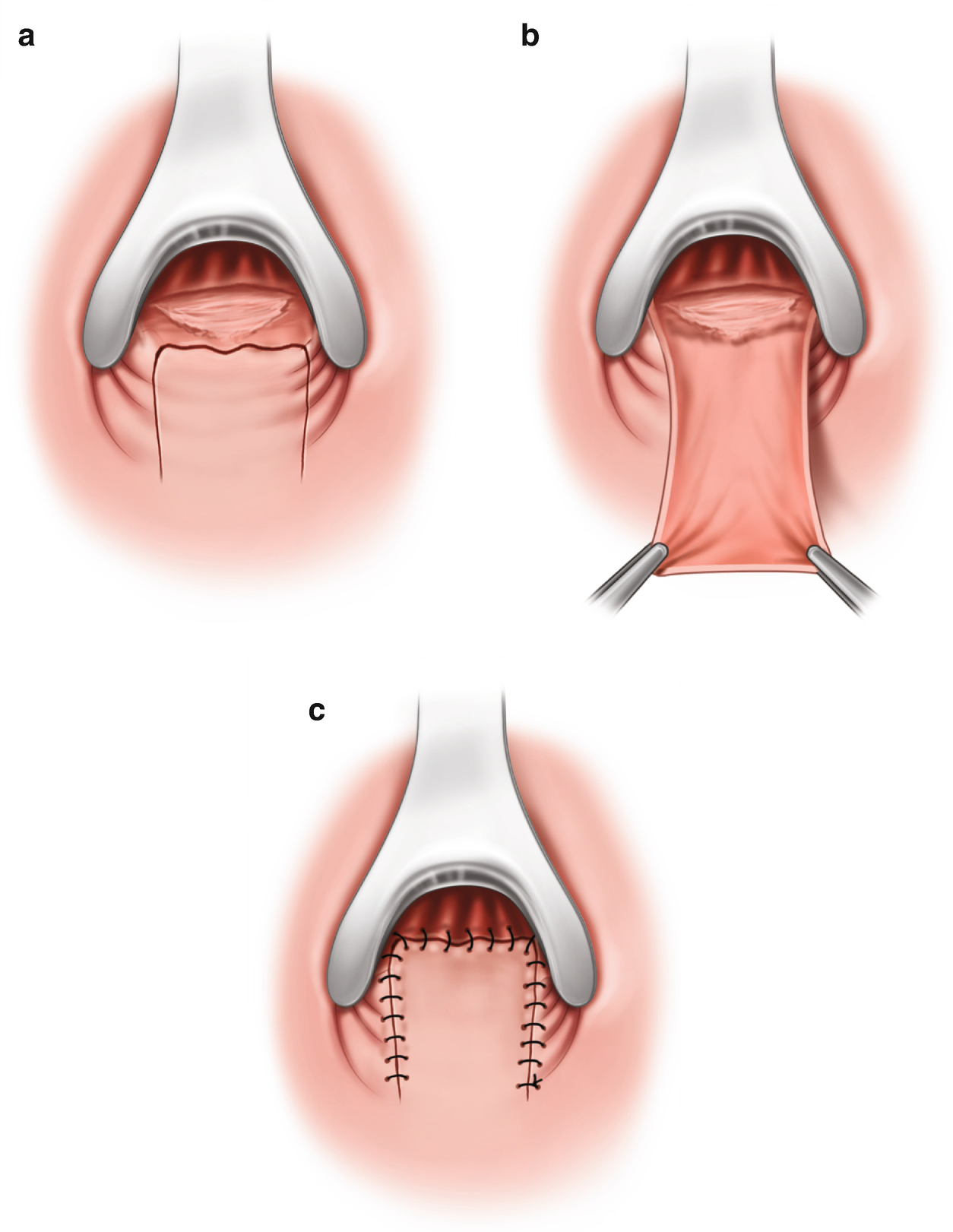 A vaginal fissure what is Posterior Fourchette