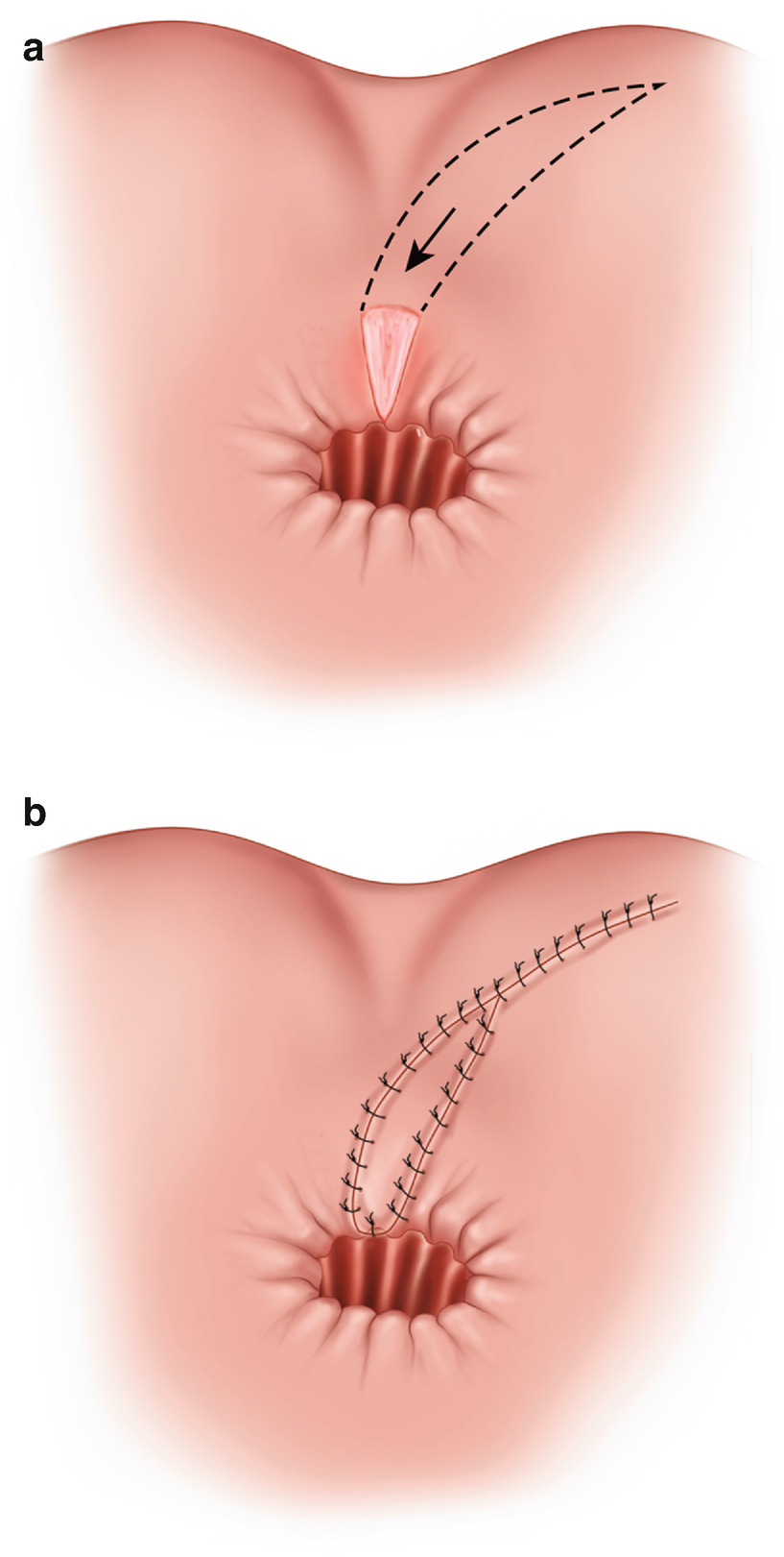 Anal stricture porn