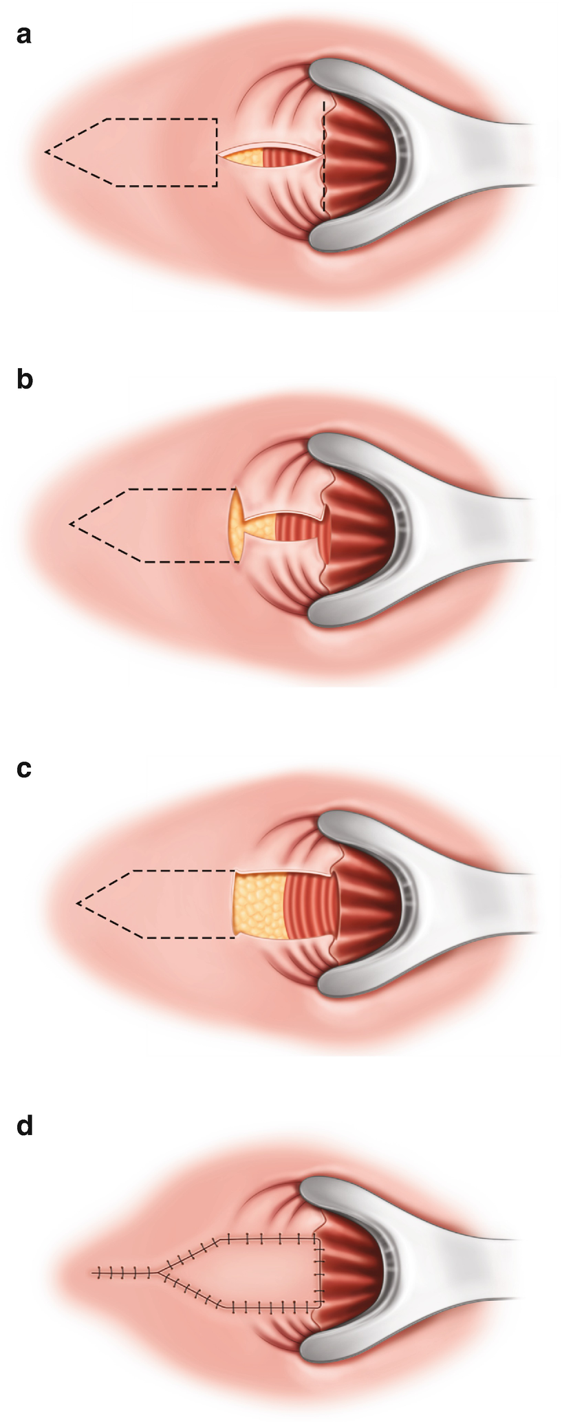 Anal stricture porn