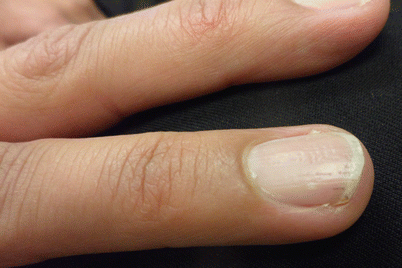 urea for nail psoriasis