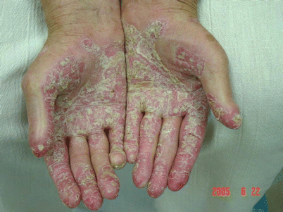 Palmoplantar psoriasis fórum kezelése