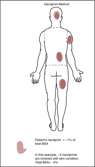 psoriasis bsa chart)