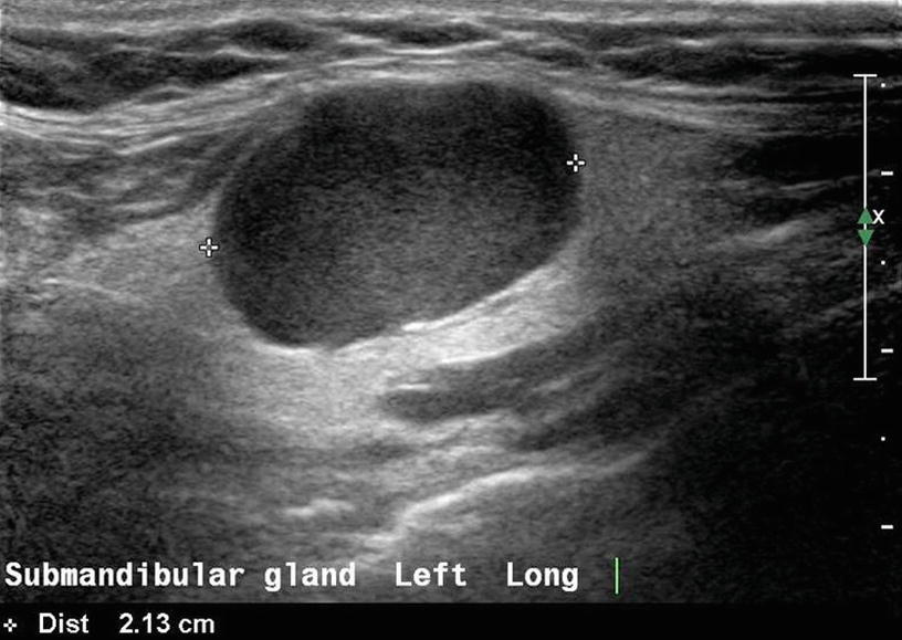 Ultrasound Of Salivary Glands And The Non Endocrine Neck Springerlink