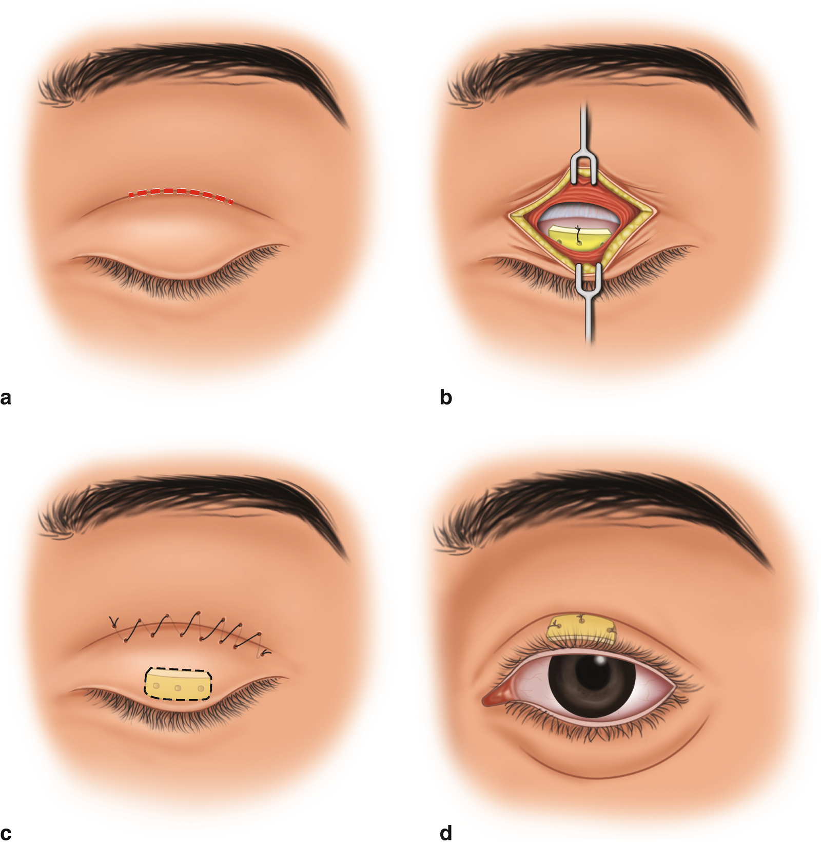 Eyelid Retraction And Lagophthalmos Springerlink