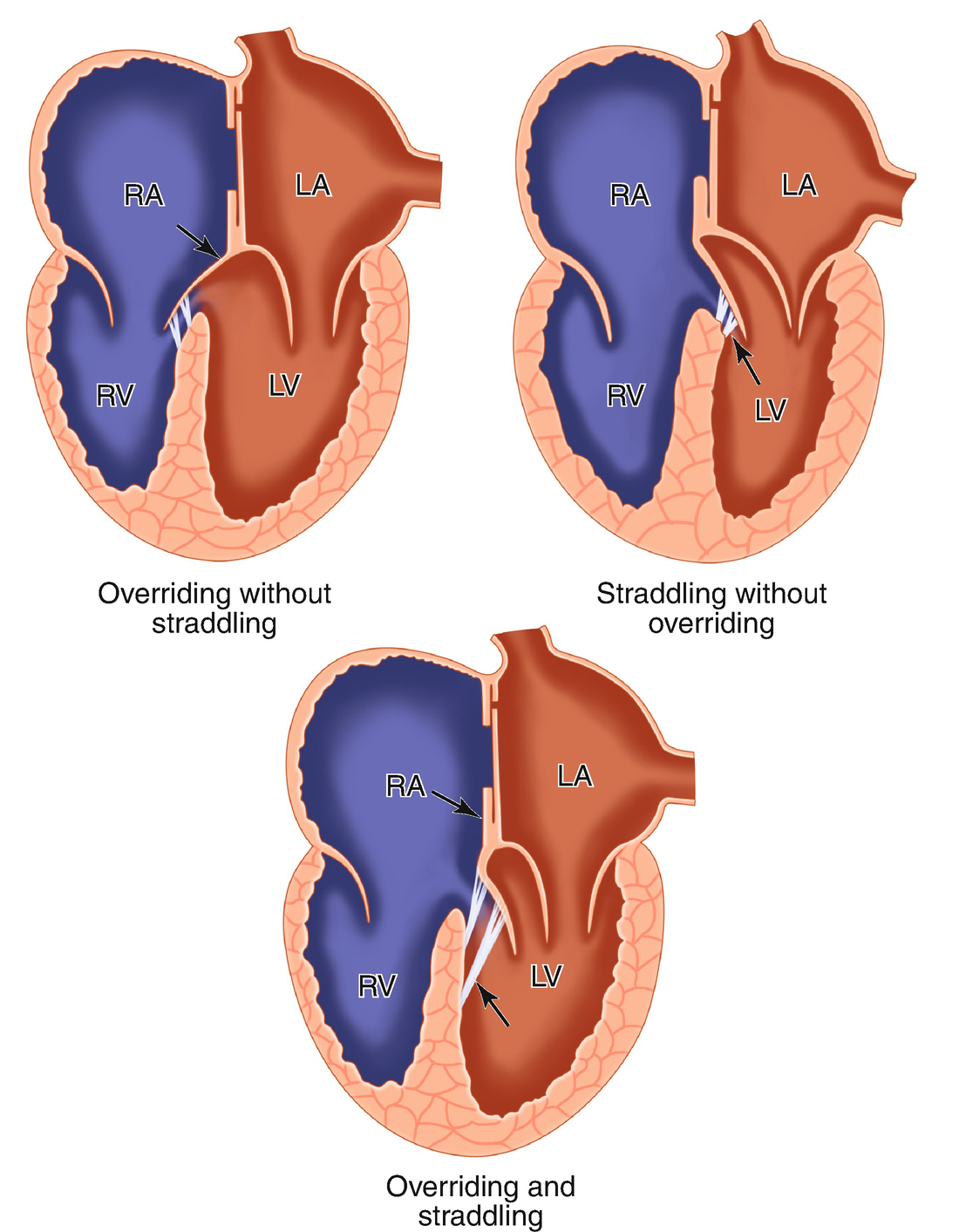 Overriding Aorta Definition