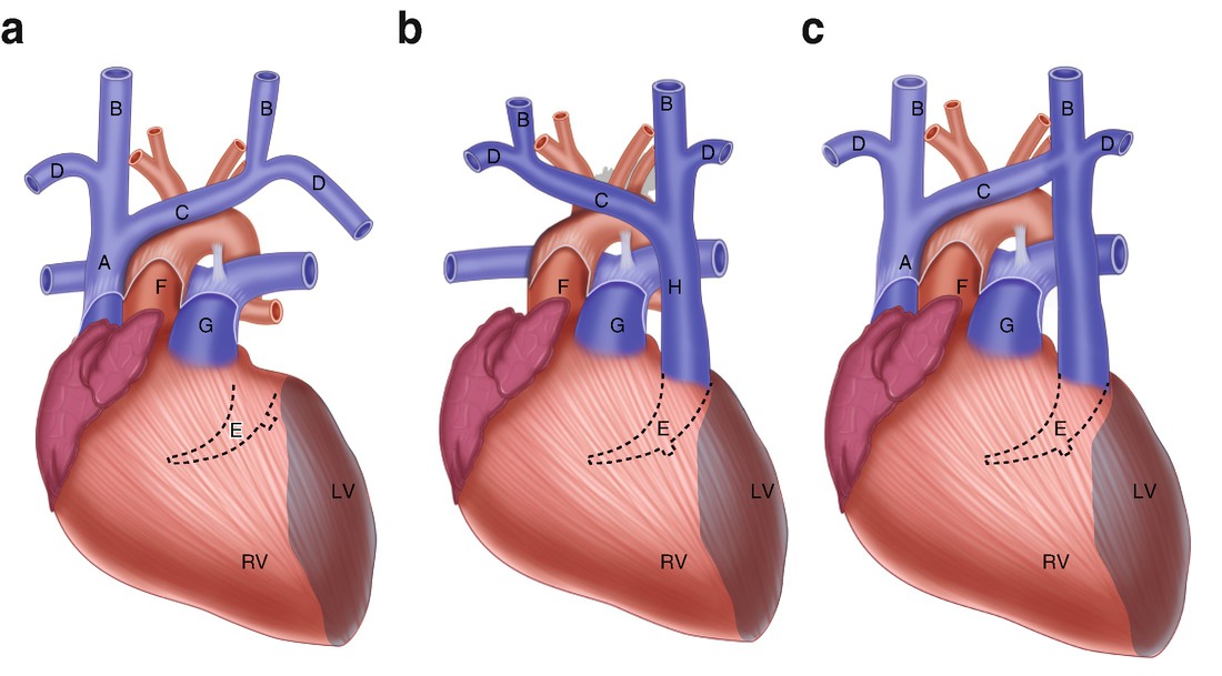 Persistent Left Superior Vena Cava Springerlink