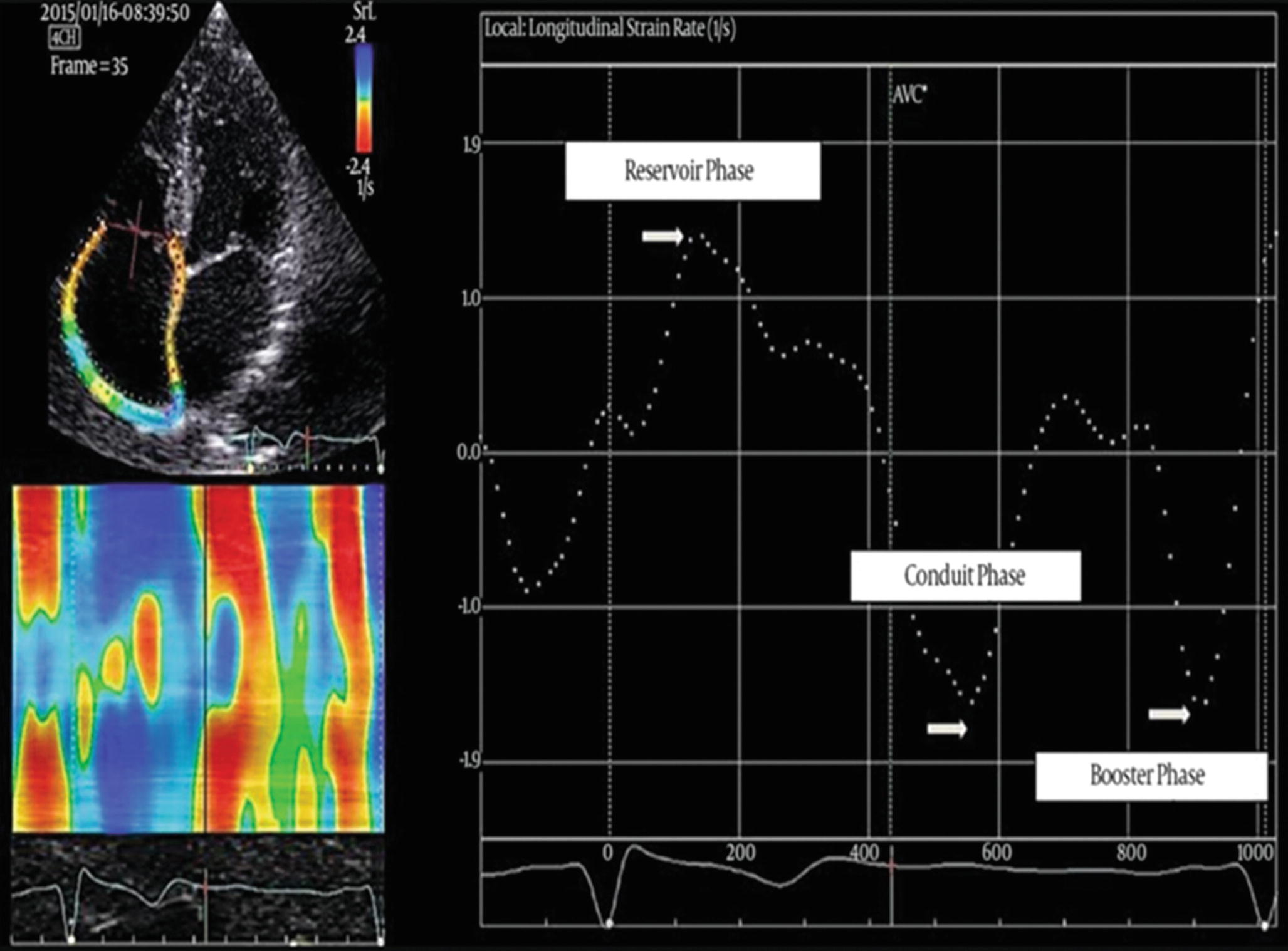 Myocardial ... Assessment of Mechanics Echocardiographic ... of Echocardiographic Mechanics Assessment Myocardial