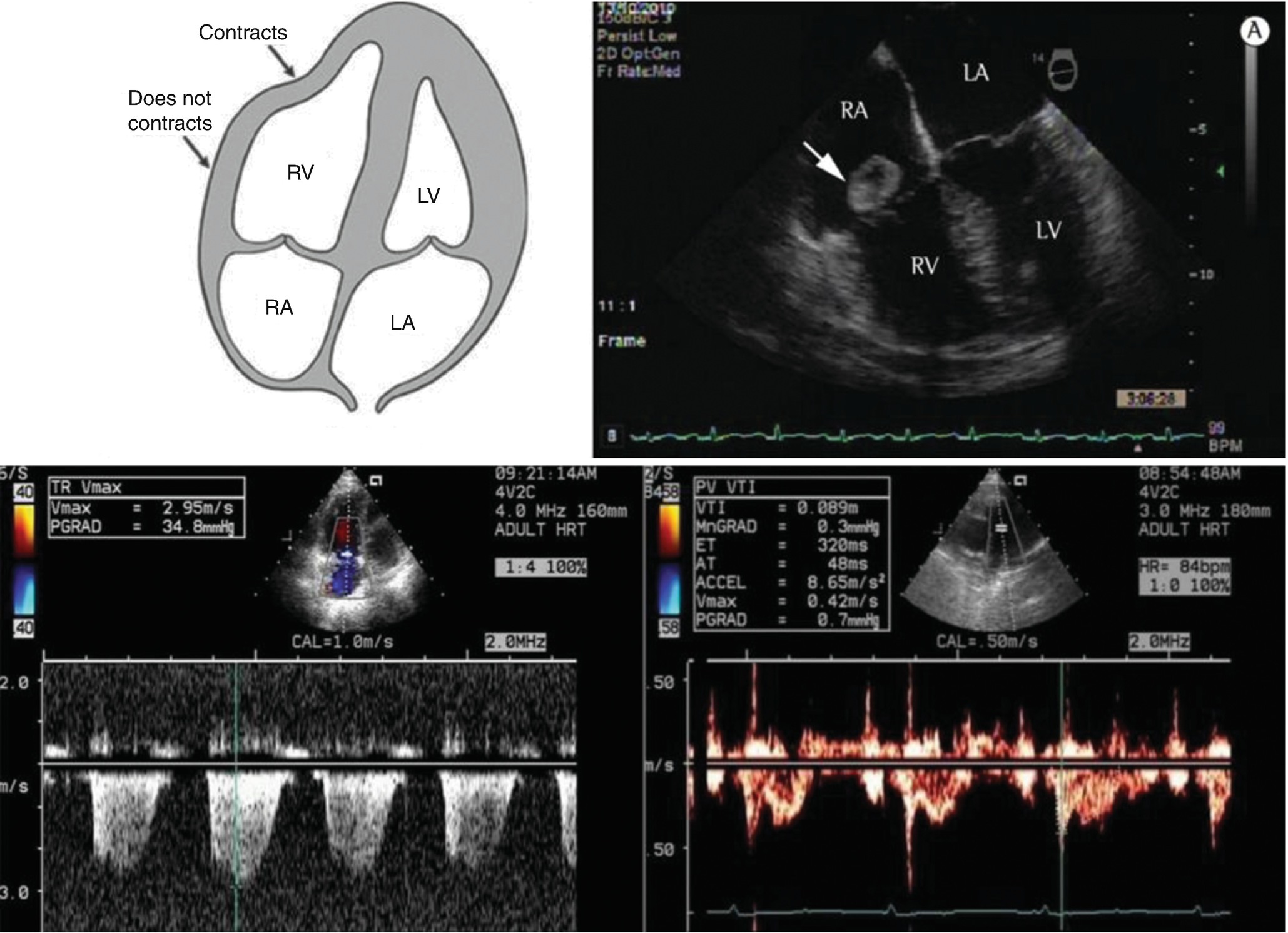 Echocardiographic Evaluation Of The Right Heart Springerlink Echocardiographic Evaluation Of The Right Heart Springerlink