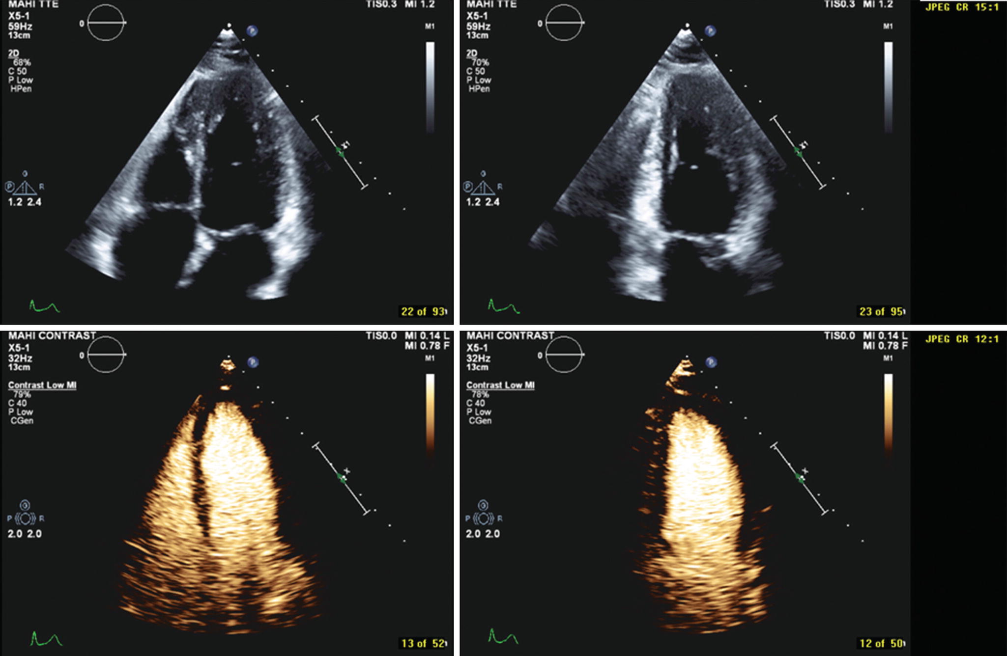 Contrast Echocardiography Springerlink